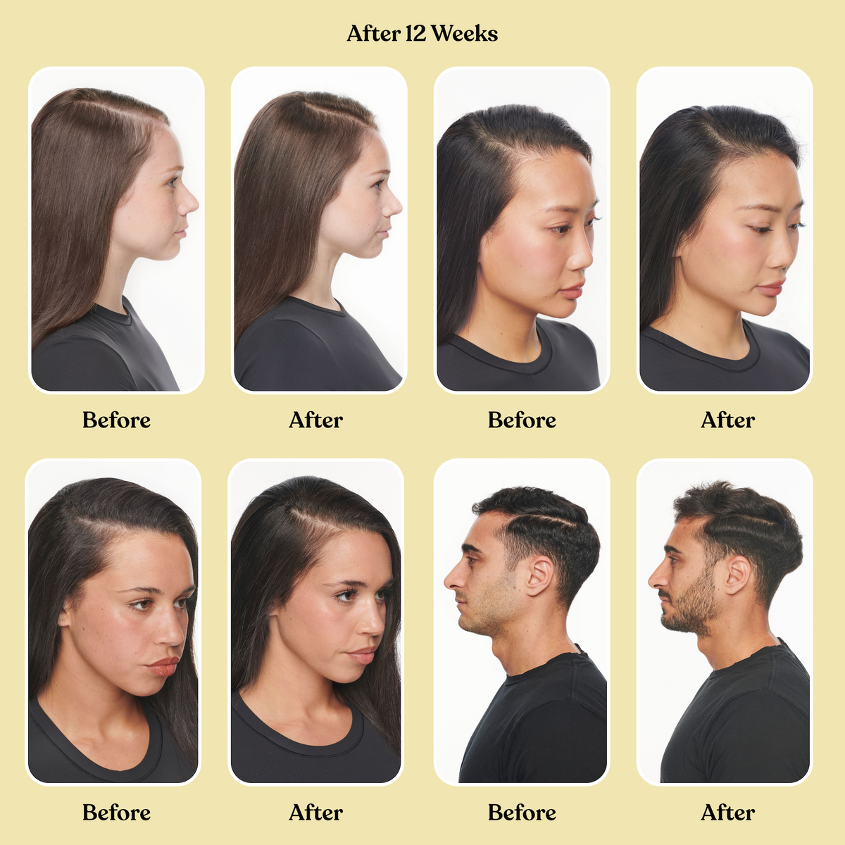 before and after of several humans showing hair growth  
